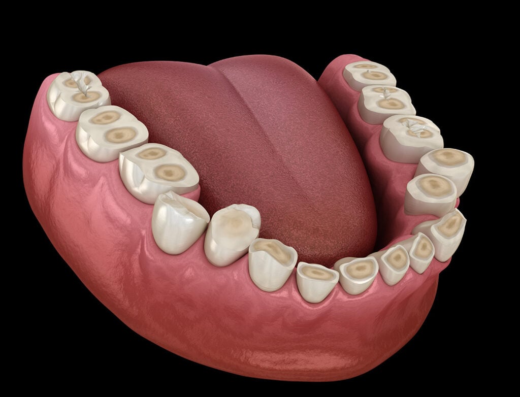 3D illustration of a lower jaw with severe tooth wear and damage, exposing dentin on multiple teeth, and the tongue visible in the background.