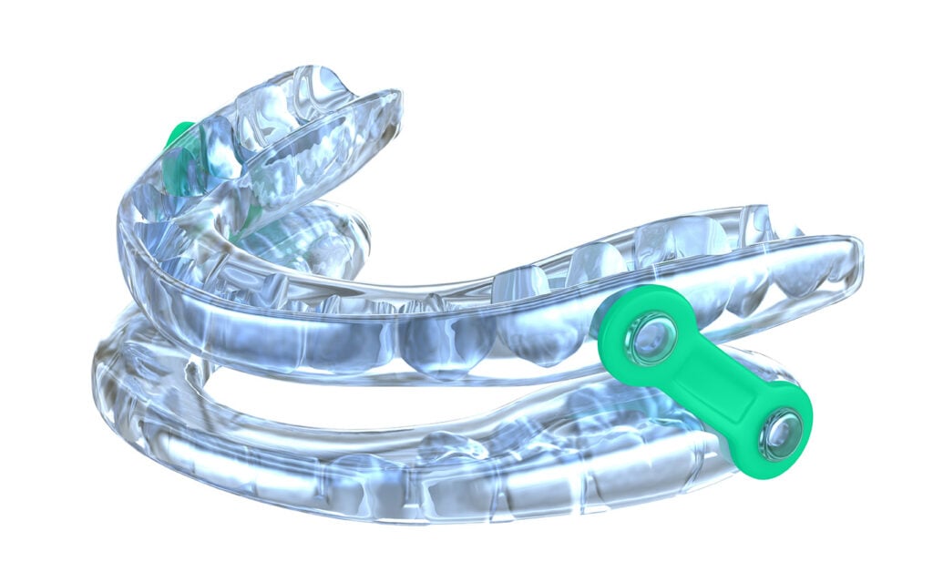 Clear plastic mandibular advancement device with green connectors, designed for oral appliance therapy to fit over teeth and treat sleep apnea or snoring—ideal for those with CPAP intolerance. Shown on a white background.